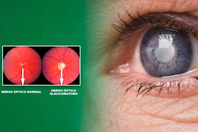 Como identificar os sintomas do glaucoma e como buscar tratamento pelo SUS?