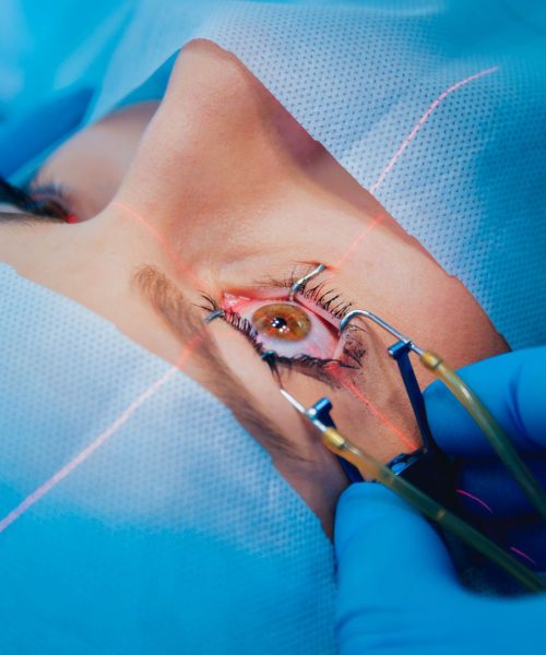 Um pouco mais sobre cirurgia refrativa